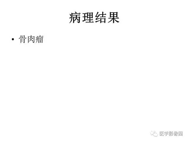 【病例】股骨骨肉瘤1例MR