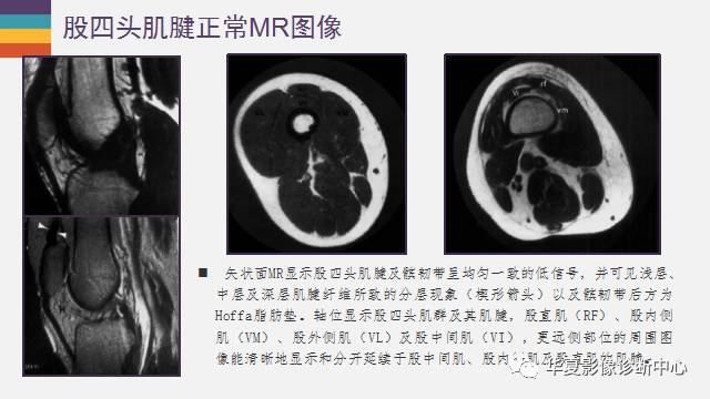 【PPT】膝关节周围肌腱解剖及MR表现
