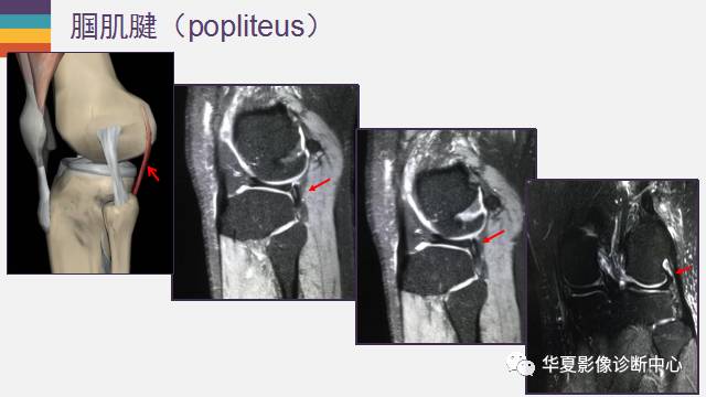 【PPT】膝关节周围肌腱解剖及MR表现