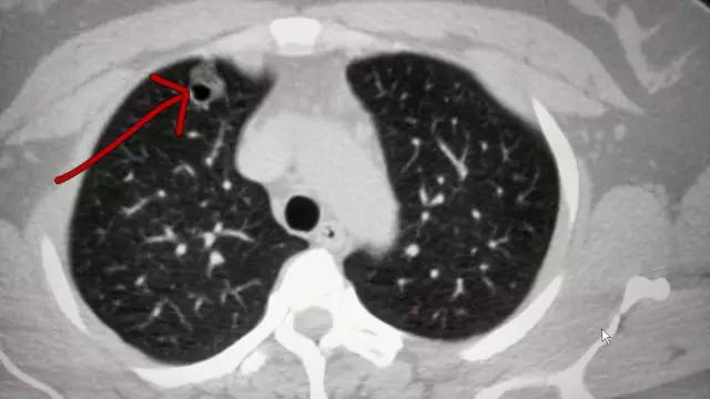 【病例】肺部子宫内膜异位症1例CT