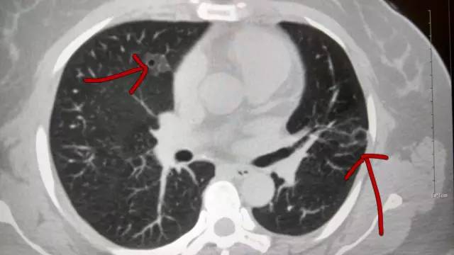 【病例】肺部子宫内膜异位症1例CT