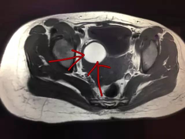 【病例】肺部子宫内膜异位症1例CT