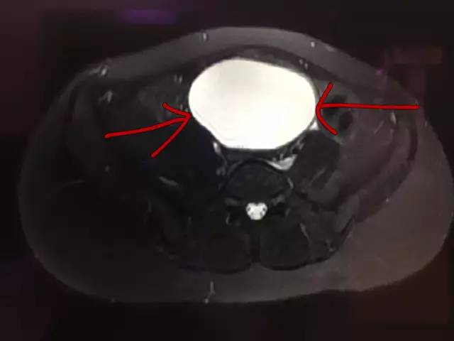【病例】肺部子宫内膜异位症1例CT