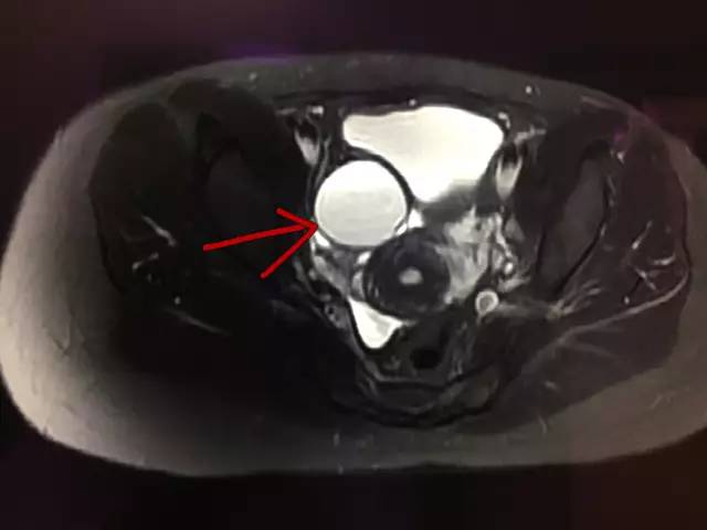 【病例】肺部子宫内膜异位症1例CT
