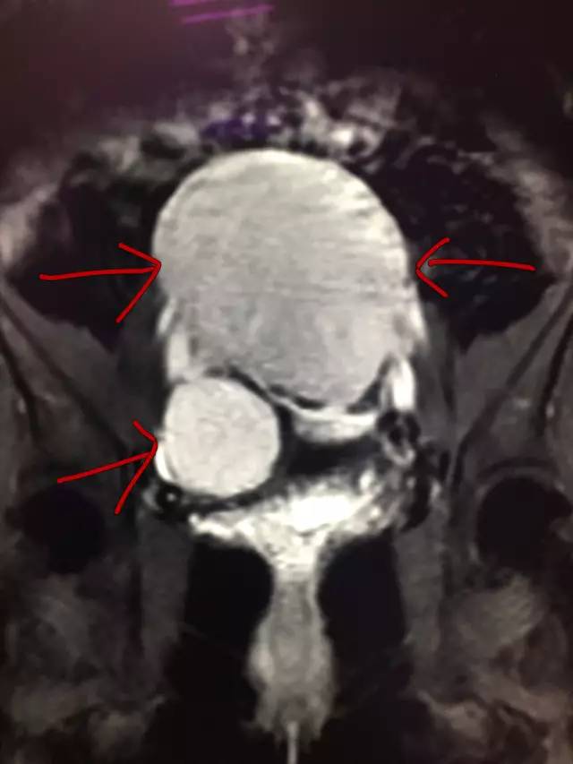 【病例】肺部子宫内膜异位症1例CT
