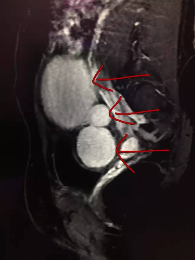 【病例】肺部子宫内膜异位症1例CT
