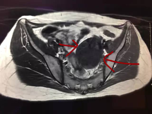 【病例】肺部子宫内膜异位症1例CT