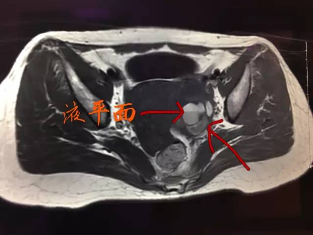 【病例】肺部子宫内膜异位症1例CT