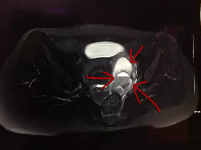 【病例】肺部子宫内膜异位症1例CT