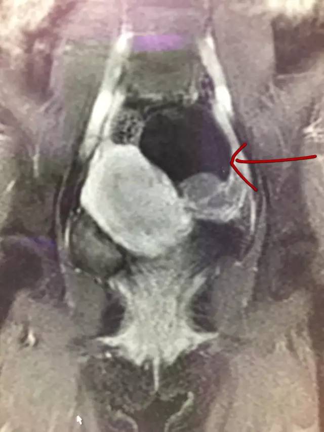 【病例】肺部子宫内膜异位症1例CT