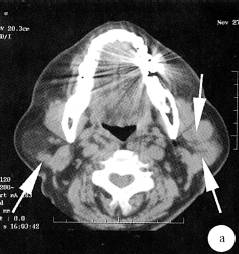 【病例】双侧腮腺腺淋巴瘤1例CT及MR 【病例】双侧腮腺腺淋巴瘤1例CT及MR