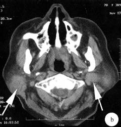 【病例】双侧腮腺腺淋巴瘤1例CT及MR 【病例】双侧腮腺腺淋巴瘤1例CT及MR
