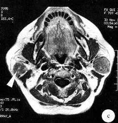 【病例】双侧腮腺腺淋巴瘤1例CT及MR 【病例】双侧腮腺腺淋巴瘤1例CT及MR