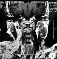【病例】双侧腮腺腺淋巴瘤1例CT及MR 【病例】双侧腮腺腺淋巴瘤1例CT及MR