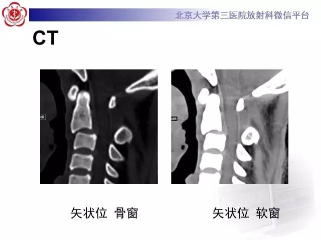 【病例】枢椎hangman骨折1例
