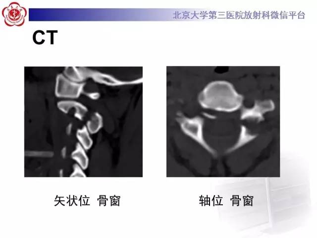 【病例】枢椎hangman骨折1例