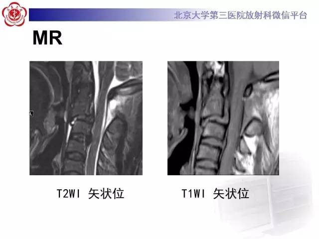 【病例】枢椎hangman骨折1例