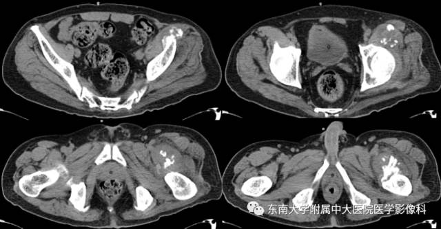 【病例】骨化性肌炎1例CT影像表现