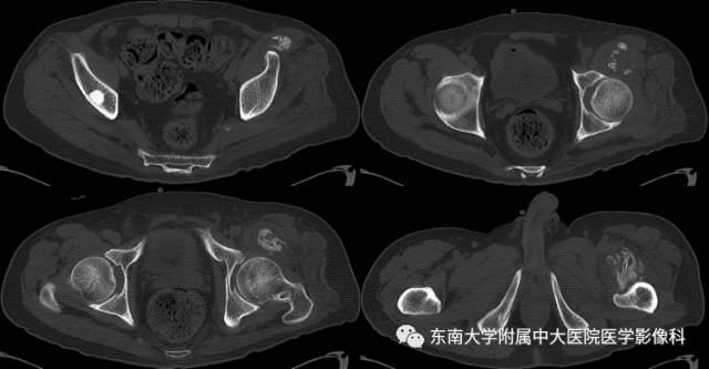 【病例】骨化性肌炎1例CT影像表现