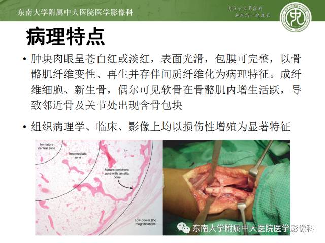 【病例】骨化性肌炎1例CT影像表现
