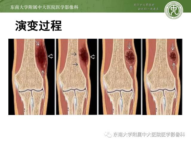 【病例】骨化性肌炎1例CT影像表现