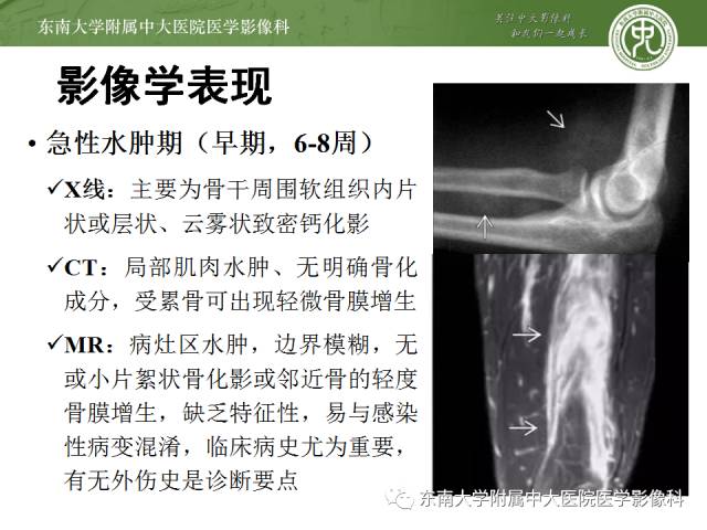 【病例】骨化性肌炎1例CT影像表现