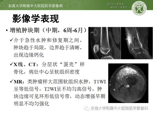 【病例】骨化性肌炎1例CT影像表现
