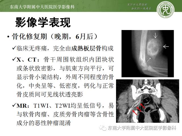 【病例】骨化性肌炎1例CT影像表现