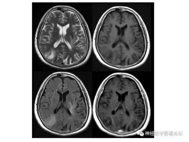 【病例】炎性脱髓鞘假瘤1例CT及MR，不除外淋巴瘤前驱