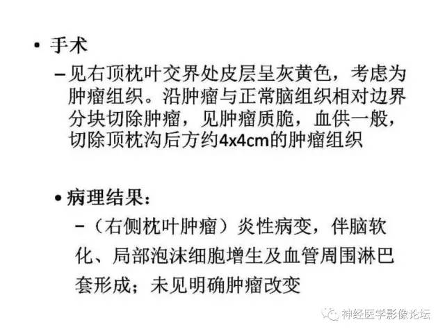 【病例】炎性脱髓鞘假瘤1例CT及MR，不除外淋巴瘤前驱