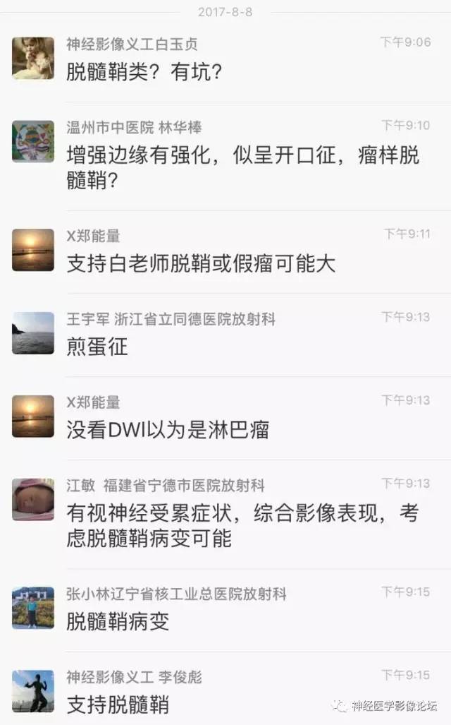 【病例】炎性脱髓鞘假瘤1例CT及MR，不除外淋巴瘤前驱