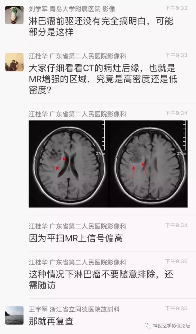 【病例】炎性脱髓鞘假瘤1例CT及MR，不除外淋巴瘤前驱