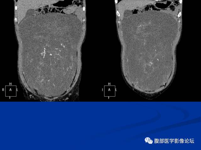 【病例】阔韧带巨大平滑肌瘤1例CT 【病例】阔韧带巨大平滑肌瘤1例CT