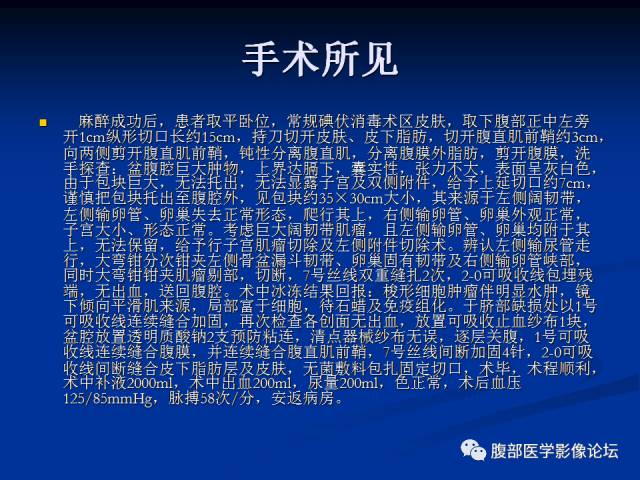 【病例】阔韧带巨大平滑肌瘤1例CT 【病例】阔韧带巨大平滑肌瘤1例CT