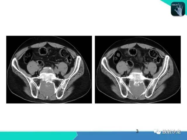 【病例】终丝粘液乳头状室管膜瘤1例CT 【病例】终丝粘液乳头状室管膜瘤1例CT