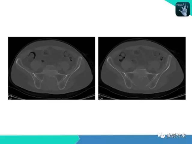 【病例】终丝粘液乳头状室管膜瘤1例CT 【病例】终丝粘液乳头状室管膜瘤1例CT