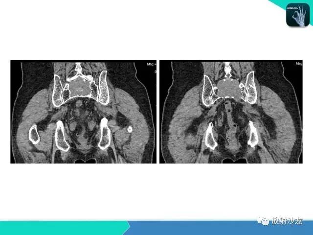 【病例】终丝粘液乳头状室管膜瘤1例CT 【病例】终丝粘液乳头状室管膜瘤1例CT
