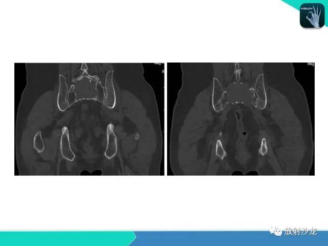 【病例】终丝粘液乳头状室管膜瘤1例CT 【病例】终丝粘液乳头状室管膜瘤1例CT