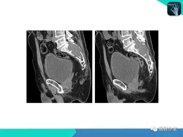 【病例】终丝粘液乳头状室管膜瘤1例CT 【病例】终丝粘液乳头状室管膜瘤1例CT