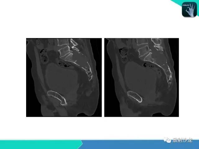 【病例】终丝粘液乳头状室管膜瘤1例CT 【病例】终丝粘液乳头状室管膜瘤1例CT