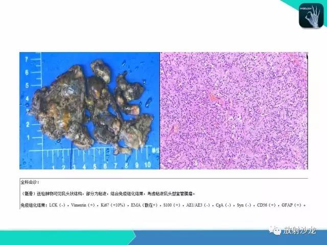 【病例】终丝粘液乳头状室管膜瘤1例CT 【病例】终丝粘液乳头状室管膜瘤1例CT