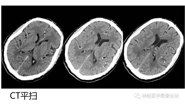 【病例】广泛脑动脉高密度征—红细胞增多症