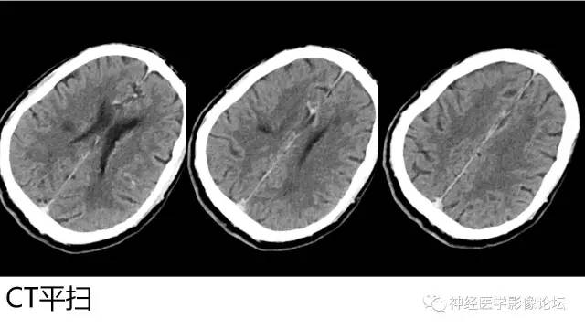 【病例】广泛脑动脉高密度征—红细胞增多症