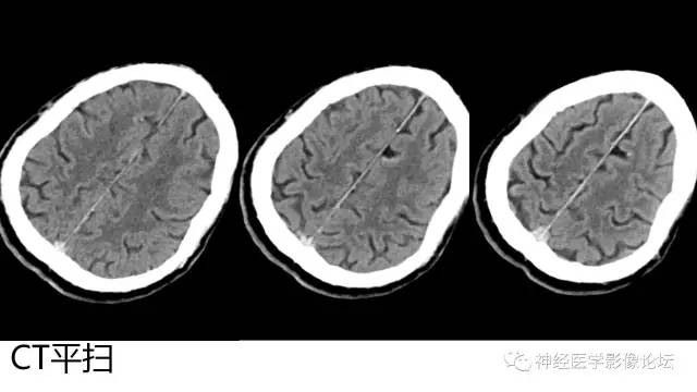 【病例】广泛脑动脉高密度征—红细胞增多症