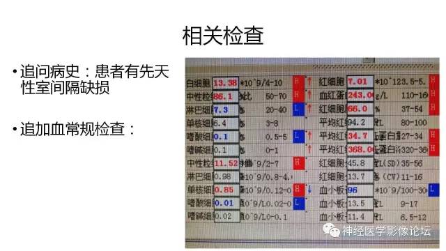 【病例】广泛脑动脉高密度征—红细胞增多症