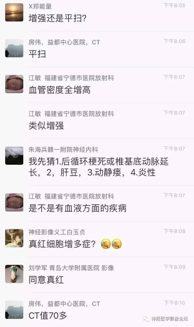 【病例】广泛脑动脉高密度征—红细胞增多症