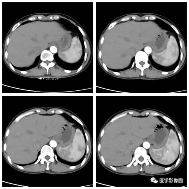 【病例】脾动脉瘤1例CT影像表现 【病例】脾动脉瘤1例CT影像表现