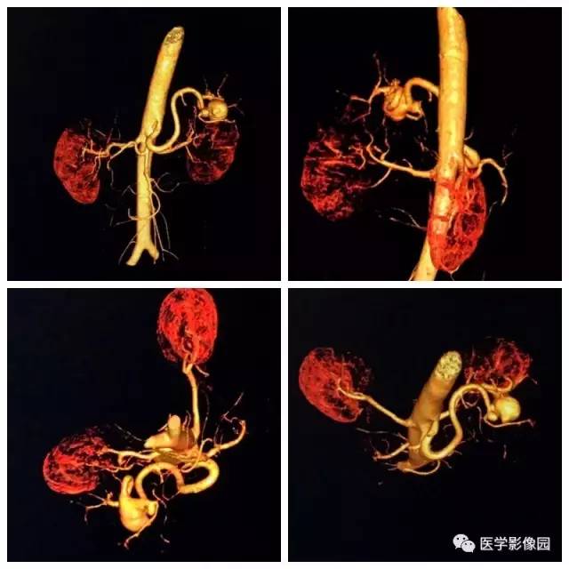 【病例】脾动脉瘤1例CT影像表现 【病例】脾动脉瘤1例CT影像表现