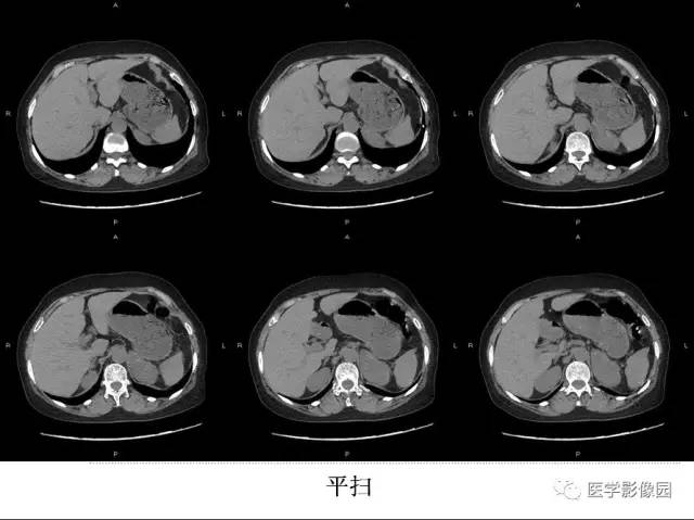 【病例】左侧肾上腺节细胞神经纤维瘤1例CT