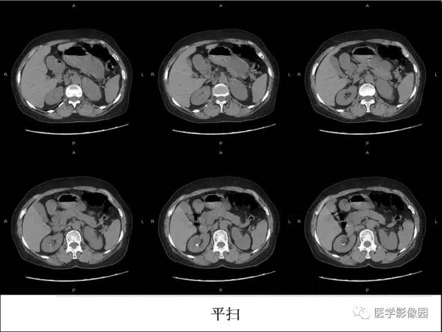【病例】左侧肾上腺节细胞神经纤维瘤1例CT 【病例】左侧肾上腺节细胞神经纤维瘤1例CT
